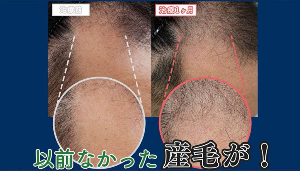 M字ハゲの薬を1か月飲んだ後のM字の改善